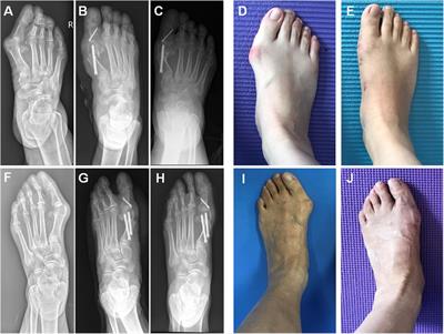 First metatarsal single-screw minimally invasive chevron-akin osteotomy: A cost effective and clinically reliable technique